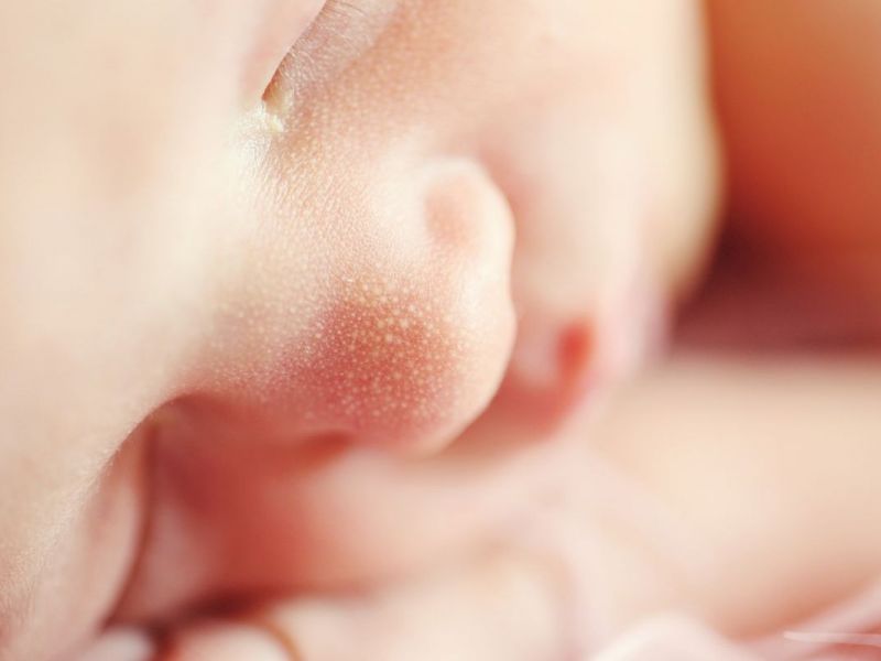 First Baby In 2017 Is Diagnosed With Herpes After Oral Suction