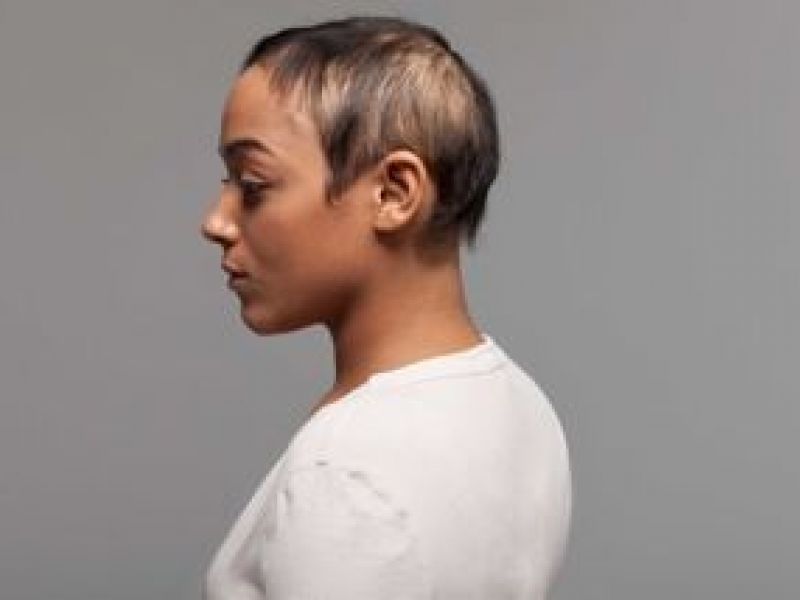 Have you noticed sudden hair loss? | Naperville, IL Patch