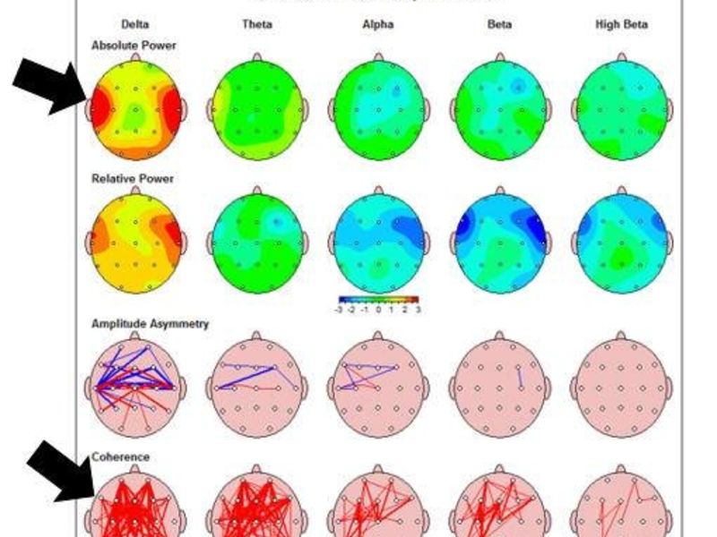 QEEG Testing is the "GPS" Map of the Brain Plainview, NY Patch