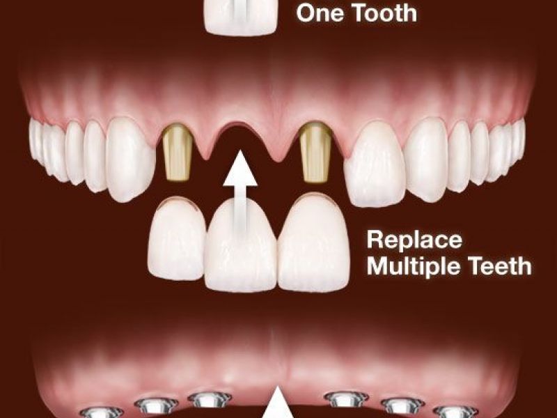 Dental Implant Special 1600.00 Includes Implant + Abutment + Crown