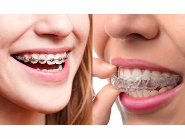 Invisalign teen effectively straightens teeth shaking, support Invisalign teen effectively straightens teeth assured