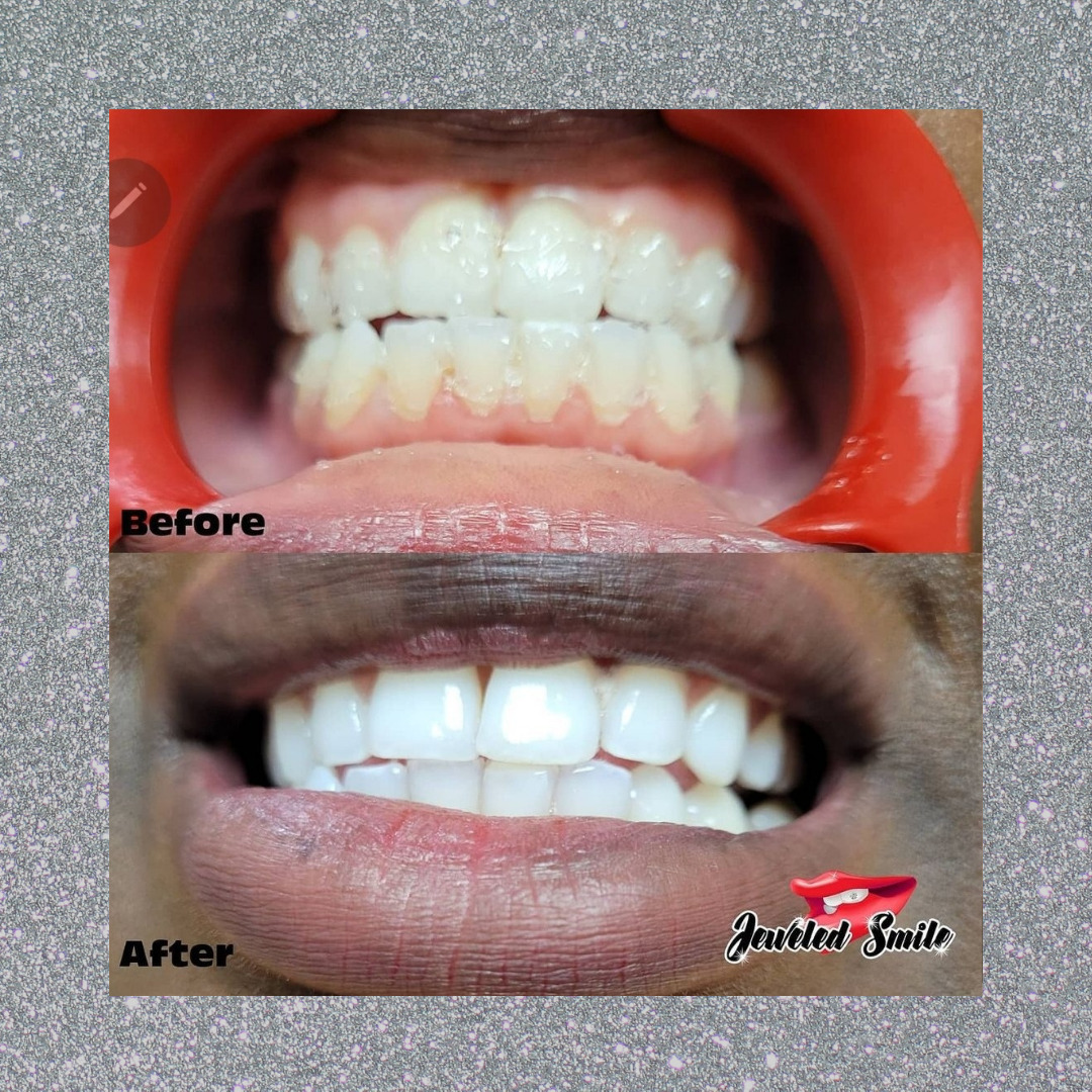 Teeth Whitening and Tooth Gems Long Island, NY Patch