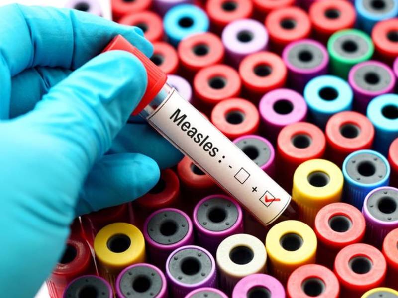 Measles Return Confirmed In Illinois, 26 Other States